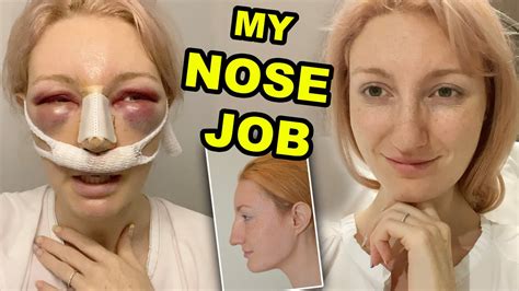Brisk bleeding from the nose or excessive drowsiness and confusion. . Nose still blocked months after septoplasty reddit